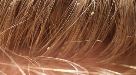 Empty nit casing on a hair shaft