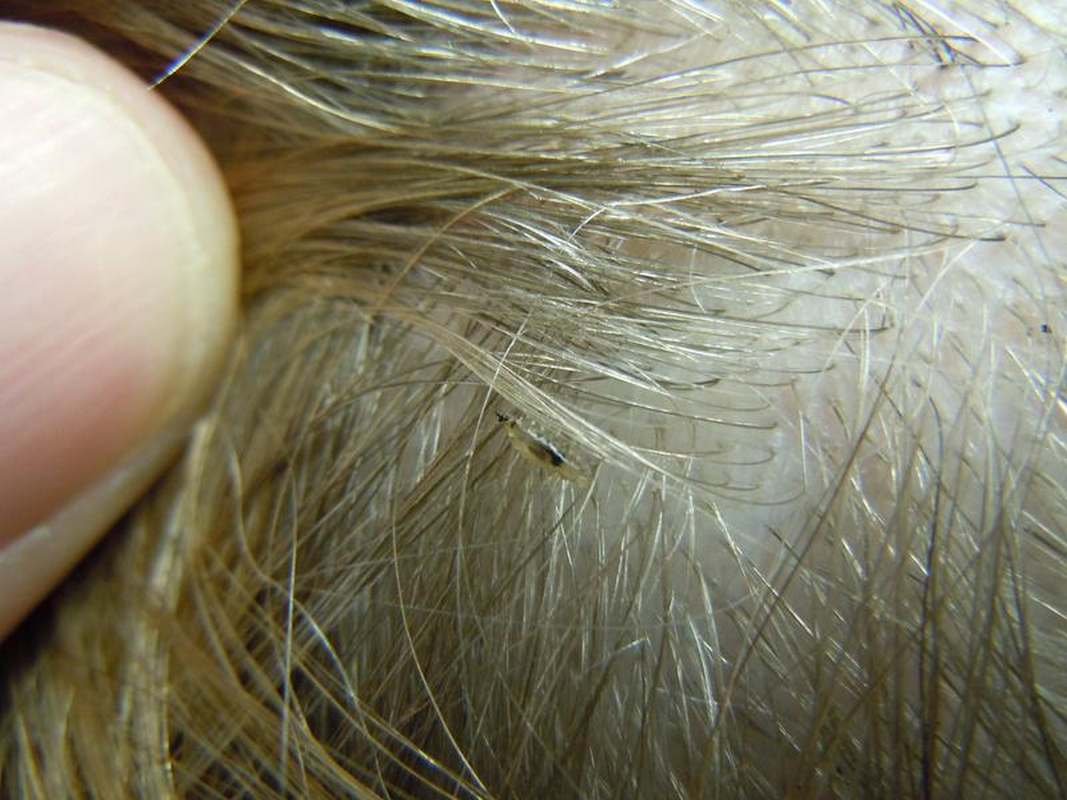Head louse on hair, close-up